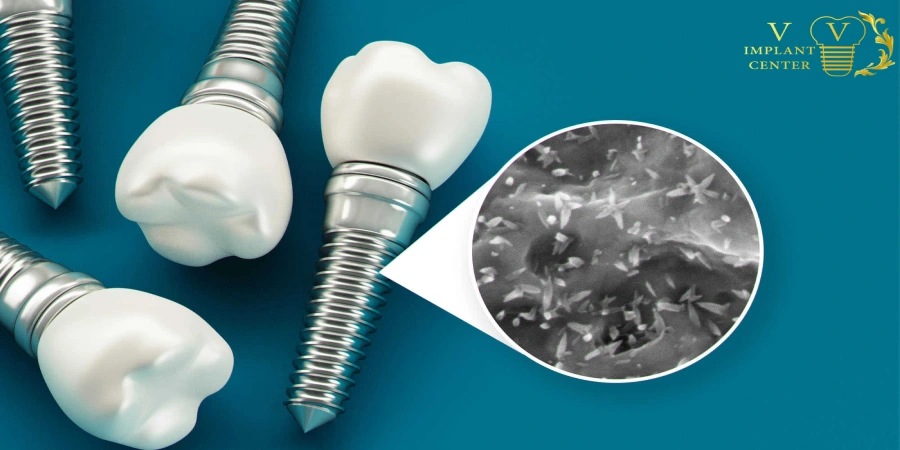 مواد و تکنولوژی ایمپلنت در انتخاب ایمپلنت توسط بهترین دکتر ایمپلنت در تهران