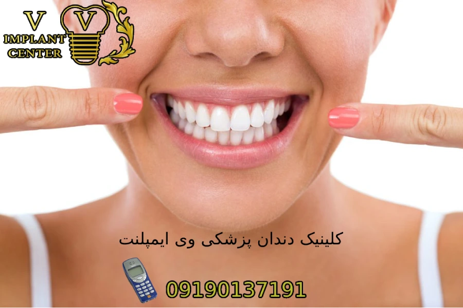 لمینت -کلینیک وی ایمپلنت