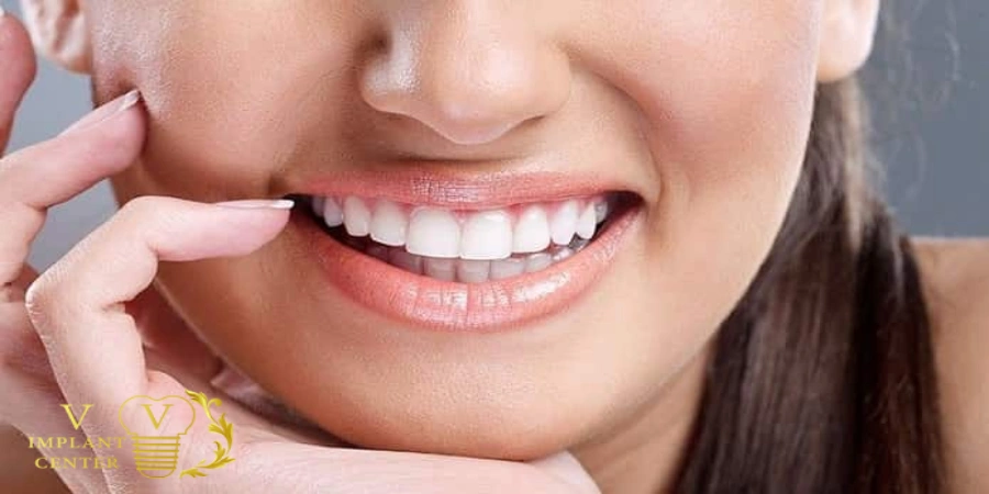 لمینت کامپوزیتی-کلینیک وی امپلنت