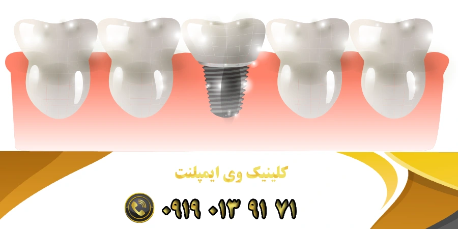 انواع ایمپلنت