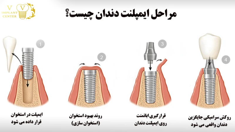 مراحل کاشت ایمپلنت در تهران