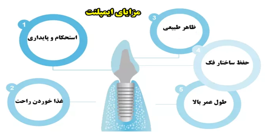 مزایای ایمپلنت دندان
