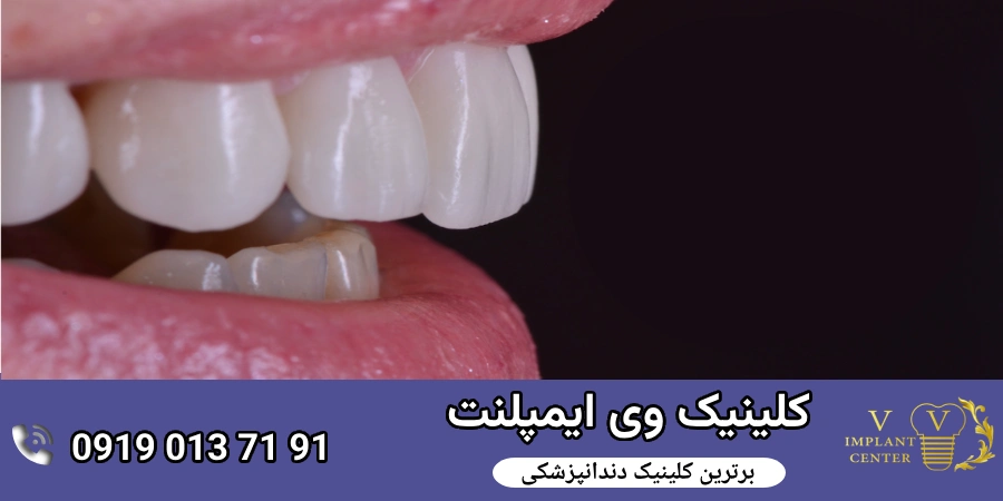 روکش زیرکونیا