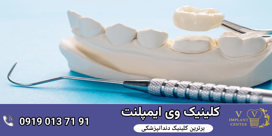 نصب پوشش زیرکونیا در دندانپزشکی