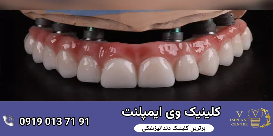 نکات مهم قبل از انتخاب روکش زیرکونیا