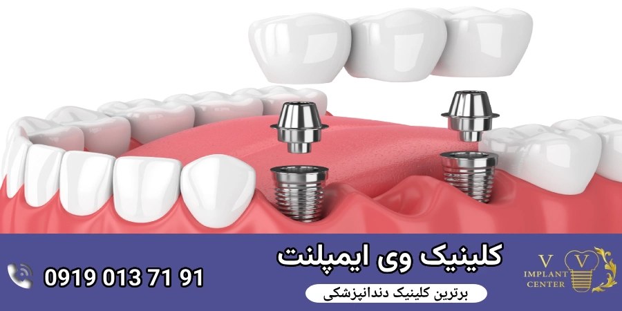  ایمپلنت دندان چیست؟