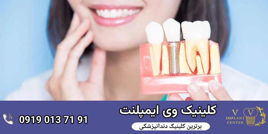  نحوه مراقبت از ایمپلنت‌های دندانی برای افزایش طول عمر