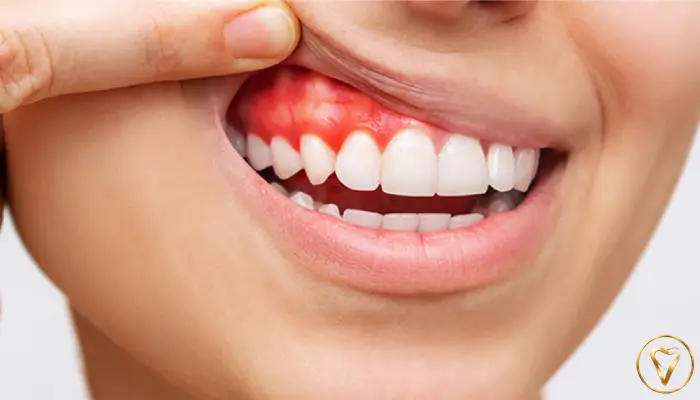 تحلیل لثه چیست؟