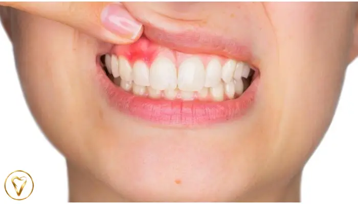 تفاوت تحلیل لثه با التهاب لثه چیست؟