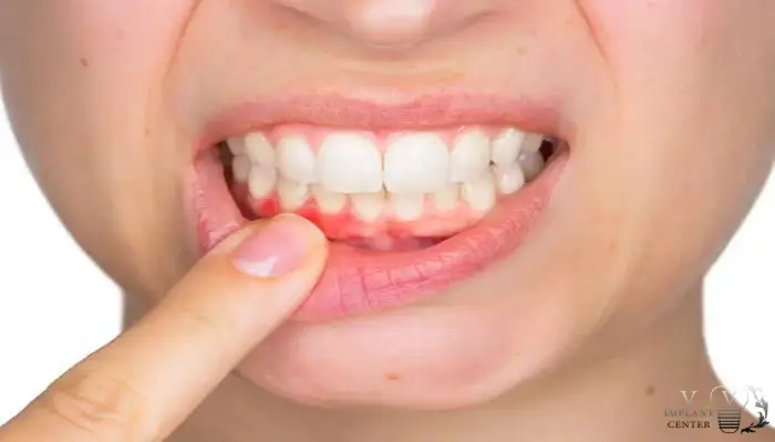 خونریزی و قرمزی لثه بعد از کامپوزیت