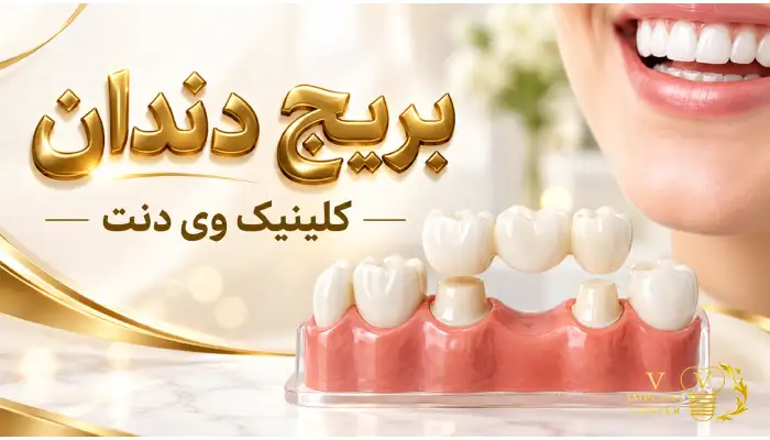 بریج دندان و نحوه جایگزینی دندان از دست رفته
