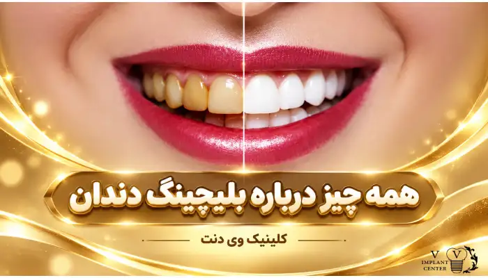 بلیچینگ دندان برای چه کسانی مناسب است