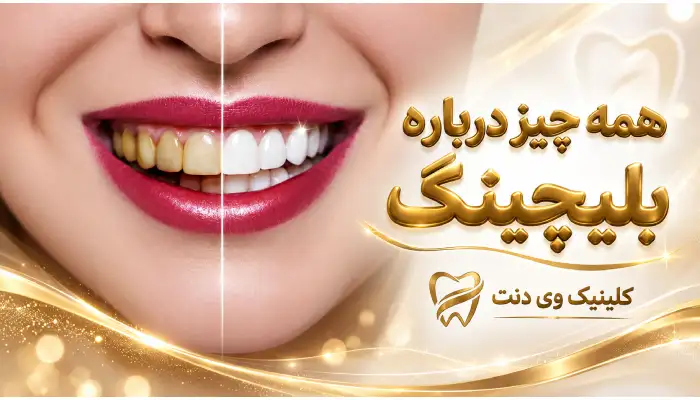 بلیچینگ دندان- کلینیک وی دنت