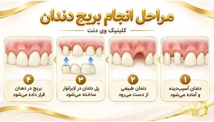 مراحل انجام بریج دندان از آماده سازی تا نصب
